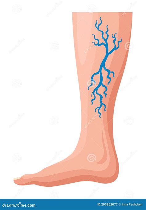 Stages Or Types Of Varicose Veins Development Medical Poster Or