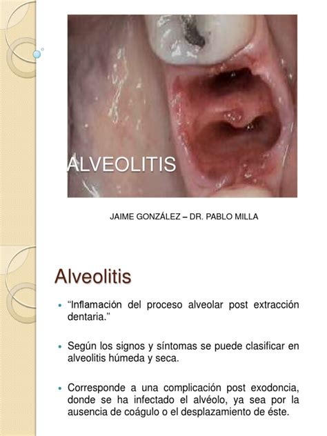 Alveolitis 130527180045 Phpapp02 Pdf Cuidado De La Salud Ciencias De La Salud