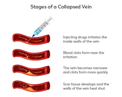 What Is A Collapsed Vein Ask Our Doctors By Journeypure
