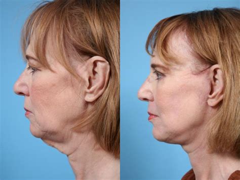 Neck Lift Before And After Pictures Case 68 Chicago Il Tlkm