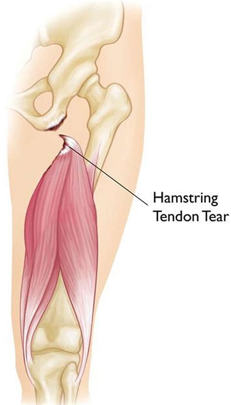 Hamstring Injury Causes Symptoms Recovery Time Treatment