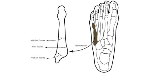 Illustration Diagram Of The 5th Metatarsal Fractures Types And Zones