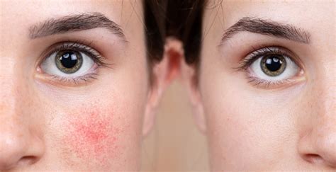 How To Care For Rosacea Prone Skin All Things Beauty