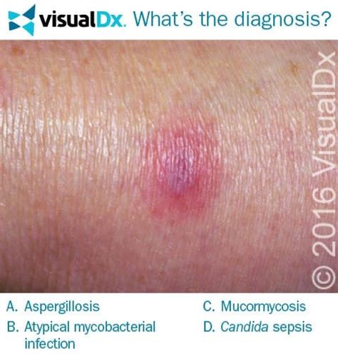 Woman On Chemo Worried About Leg Rash Lets Diagnose Visualdx