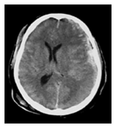 Case Progressive Epidural Hematoma In A Year Old Man After Motor