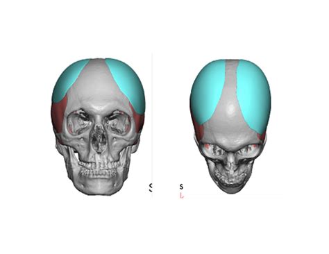 Blog Archivecase Study Custom Skull Implants For Head Widening