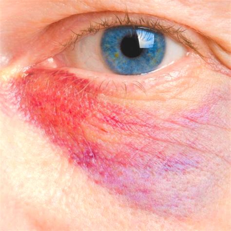 Bruises Makeup Artofit