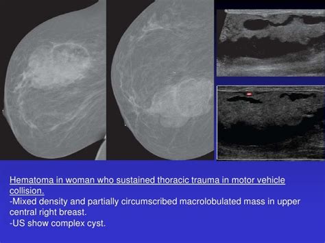 Cystic Masses Of The Breast By Xiu