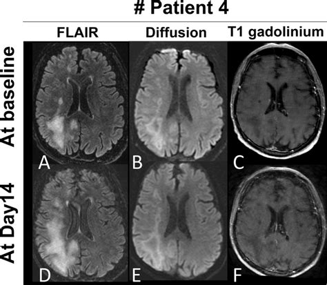 Baseline And Follow Up Brain Mris Of The Patient 4 T2 Flair A D