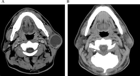 Hiv Associated Cystic Lesions Of The Parotid Gland Auris Nasus Larynx