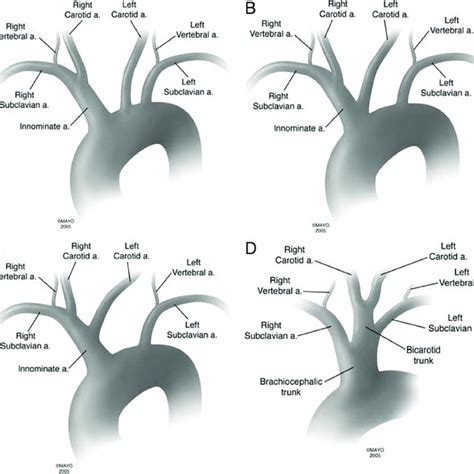 The Vertebral Artery And Its Four Segments V1 V2 V3 V4 Download