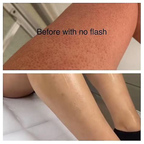 Strawberry Legs Cream Fades Strawberry Spots All Over Skin Smooth Strawberry Legs Exfoliating