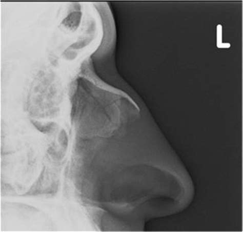 They are placed side by side at the middle and upper part of the face and by their junction. Nasal Bone Fracture- Grey Zone - Sumer's Radiology Blog