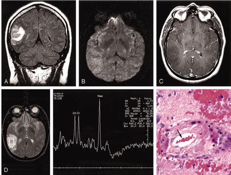 Mr Spectroscopy In The Diagnosis Of Cerebral Amyloid Angiopathy