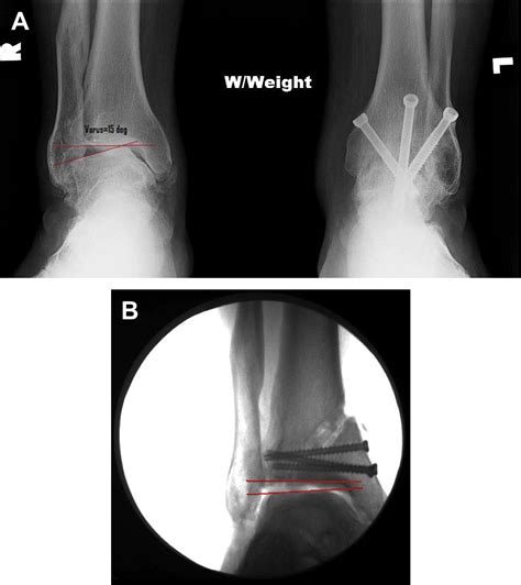 The Indications And Technique Of Supramalleolar Osteotomy Foot And