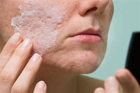 10 Tips On How To Stop Acne And Scars All You Need To Know 10 Tips
