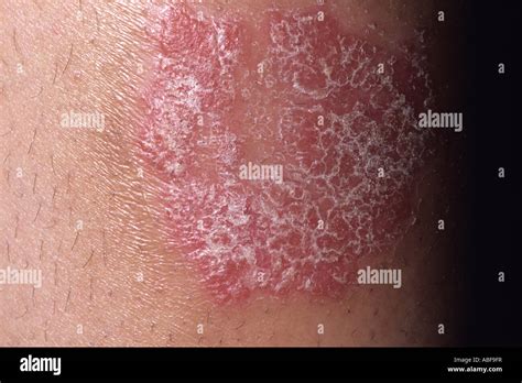 Erythematous Skin Plaque Hi Res Stock Photography And Images Alamy