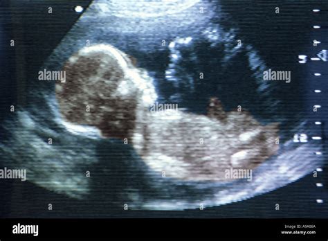 5 To 7 Month Old Fetus Seen During Ultrasound Test Stock Photo Alamy