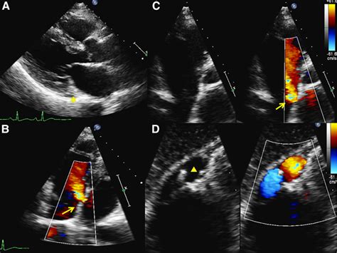 Mimic Of Atrial Septal Defect Circulation Cardiovascular Imaging