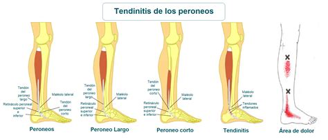 Tendinitis De Los Peroneos Qué Es Causas Síntomas Tratamiento Y