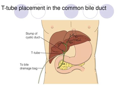 Ppt Gallbladder Disorders Powerpoint Presentation Free Download Id