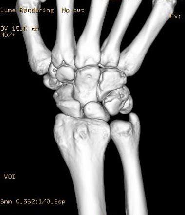 Triquetral Fracture Radiology Case Radiopaedia Org