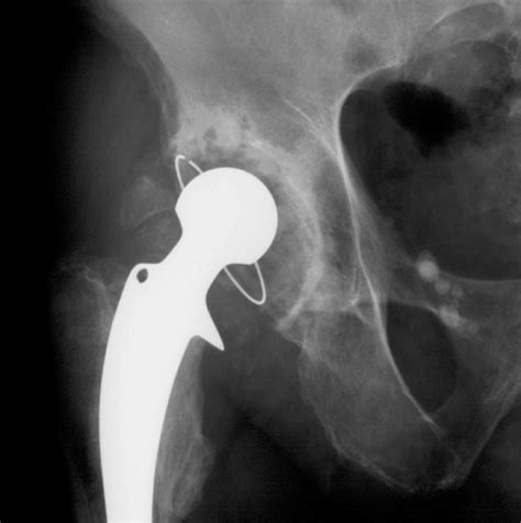 Acetabular Bone Reconstruction In Revision Arthroplasty Bone And Joint