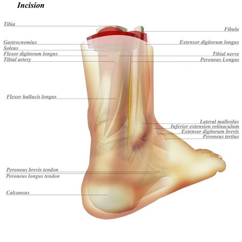 Ankle Posterolateral Approach Approaches Orthobullets