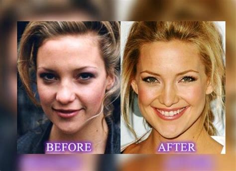 Kate Hudsons Plastic Surgery Her Transformation In Comparison To