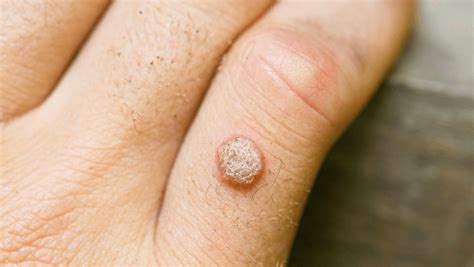 The Difference Between Wart And Mole Aspire Dermatology