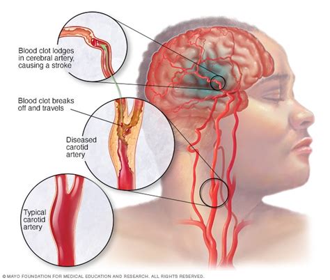 Accidente cerebrovascular isquémico Mayo Clinic