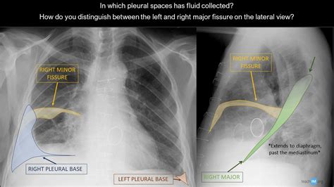 Lobes And Fissures Teachim Cxr