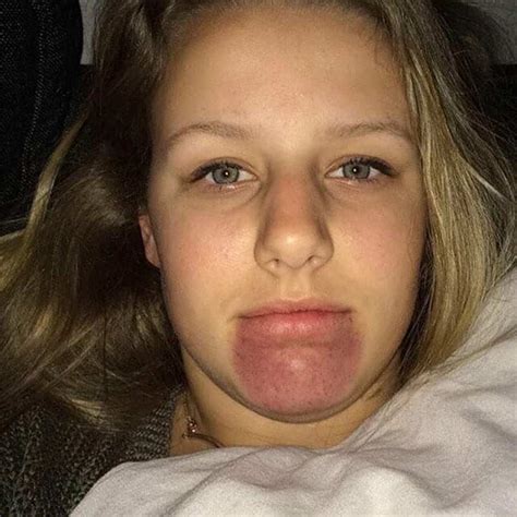 20 Reasons Why You Shouldnt Try The Kylie Jenner Lip Challenge Look