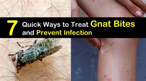 7 Quick Ways To Treat Gnat Bites And Prevent Infection