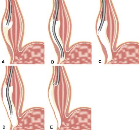 Key Steps In Peroral Endoscopic Myotomy Poem A Using Endoscopic