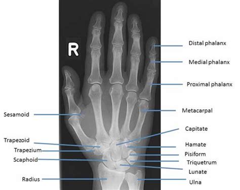 Standard Ap X Ray Of The Hand And Wrist With Labels Naming