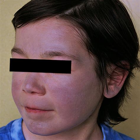 The Blue Child Amiodarone‐induced Blue‐gray Skin Syndrome And