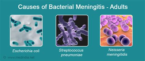 Bacterial Meningitis Causes Symptoms Diagnosis Treatment And Prevention