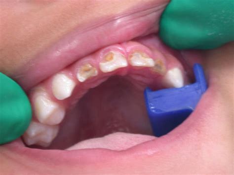 Tooth Decay More Kids Hospitalised Over Sugar In Food Drinks Daily