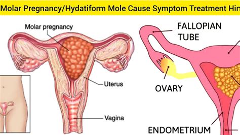 Molar Pregnancy Trophoblastic Disease Cause Symptoms Treatment Hindi