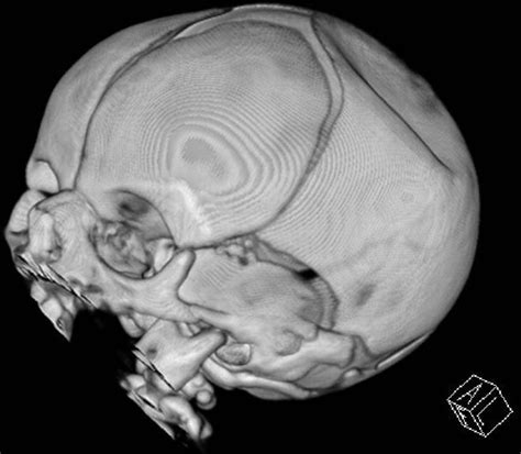 Massive Congenital Depression Of Neonates Skull Adc Fetal And Neonatal