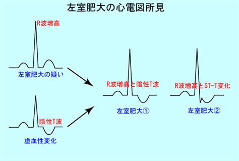 The site owner hides the web page description. 4.心肥大（左室肥大）の心電図変化｜誰でも分かる「心電図の ...