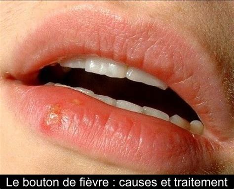 Le Bouton De Fièvre Causes Et Traitement