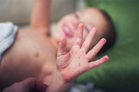 Hand Foot And Mouth Disease Causes Symptoms And Treatment Live Science