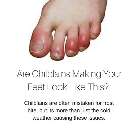 Foot Health Do You Have Cold Painful Feet In The Winter That Blister