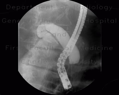 Radiology Case Stenosis Of Biliary Duct Pancreatic Carcinoma Ercp