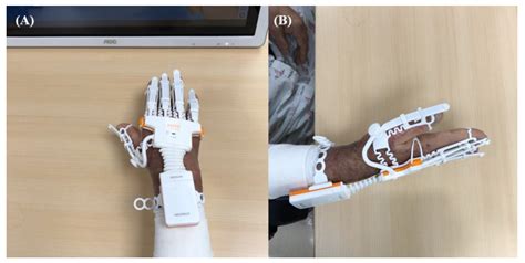 jcm free full text effects of virtual reality based rehabilitation on burned hands a
