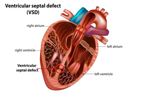 Congenital Heart Defects And Down Syndrome LuMind IDSC