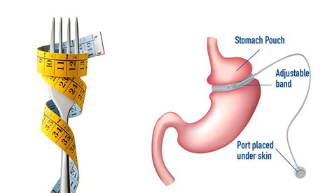 Lap Band Surgery Cost In India Gastric Band Surgery Top Hospitals