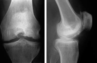 Osteoarthritis Patofisiologi Diagnosis Penatalaksanaan Alomedika